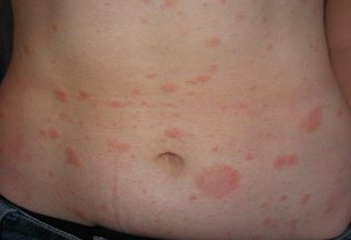 Of healing psoriasis on the body