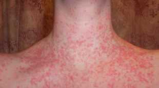 Stage and the symptoms of psoriasis