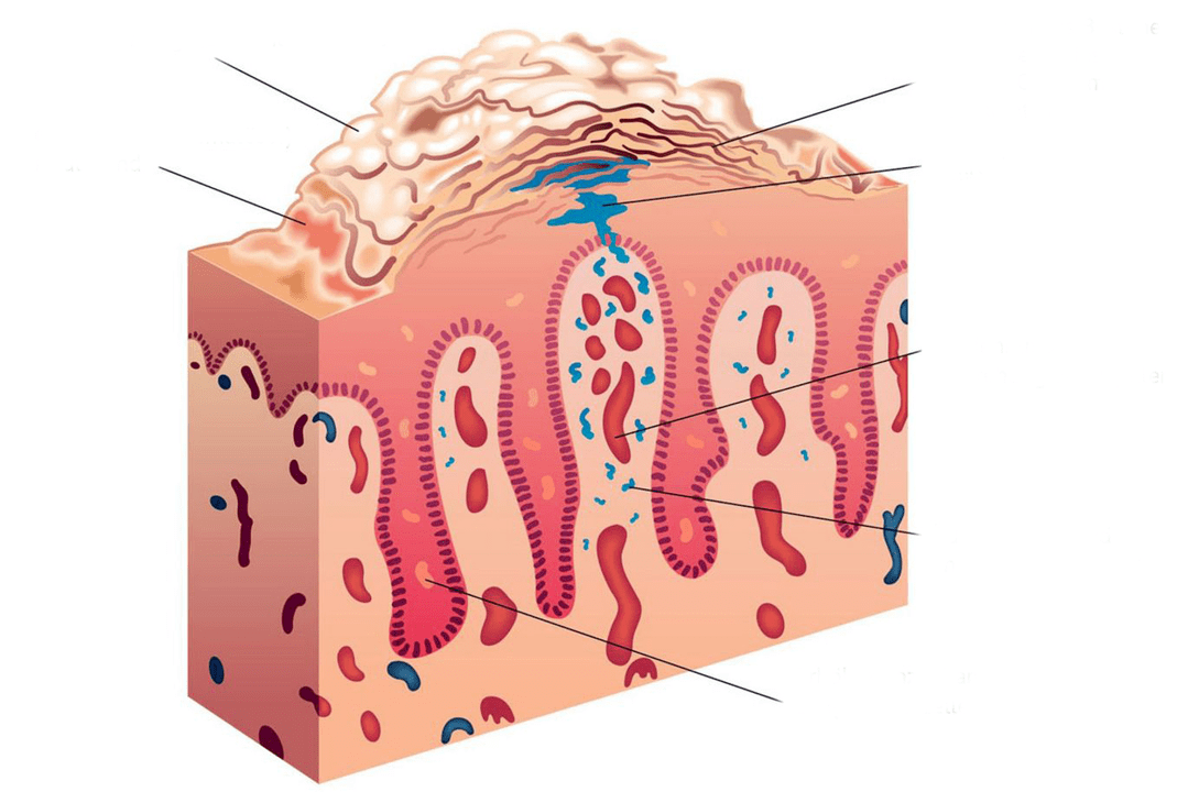 Cross section of psoriatic skin
