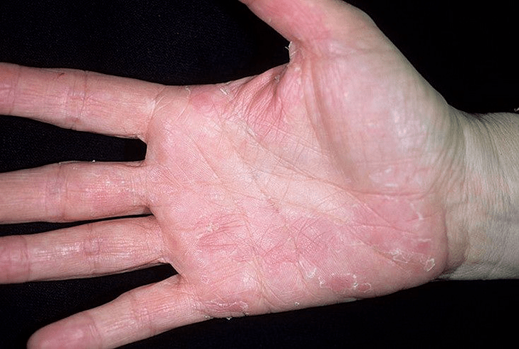 Psoriasis on the palm and underneath