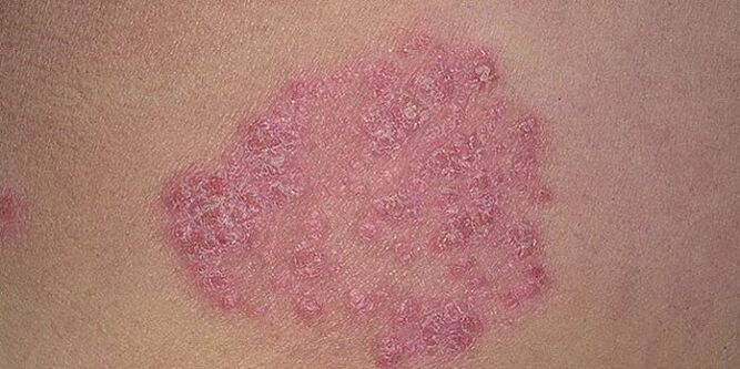 Pimples on the skin of the legs with psoriasis