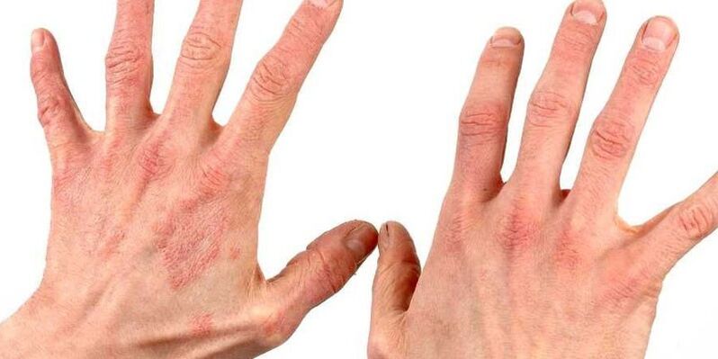 How to treat psoriasis on the hand with folk remedies