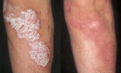 Photos before and after psoriasis treatment