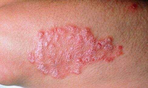 Psoriasis on the skin photo 2