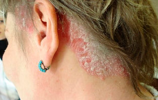 psoriasis of the scalp-part