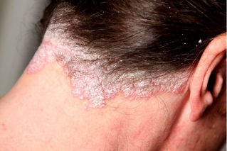 psoriasis hair of the head