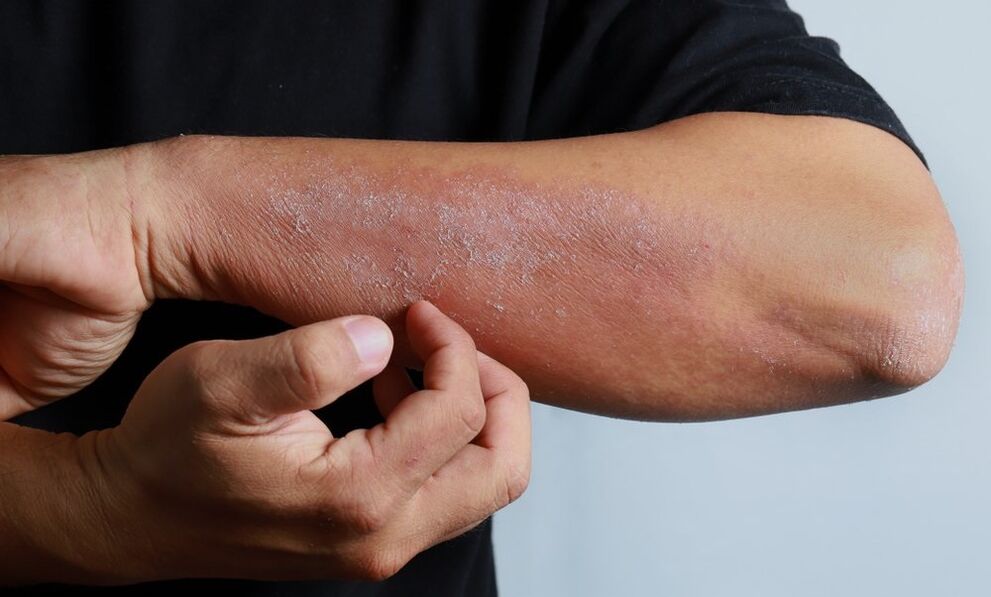 Psoriasis symptoms on the arm