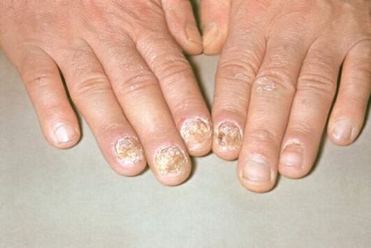 Psoriasis Nails Photos 1
