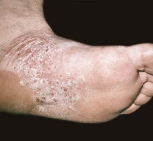 psoriasis on feet