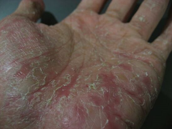 psoriasis on the palm of your hand