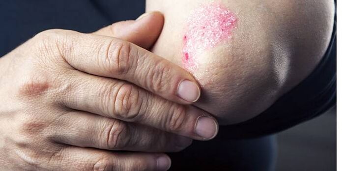 Symptoms of Elbow Psoriasis