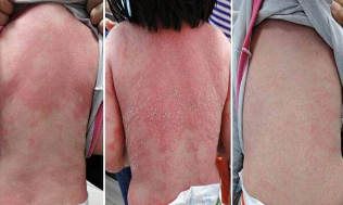 as seems to be the psoriasis in children