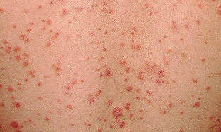as seems to be the psoriasis the initial phase