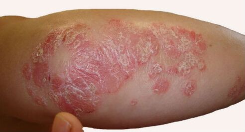 During an exacerbation of psoriasis, scaly, large patches appear on the elbows