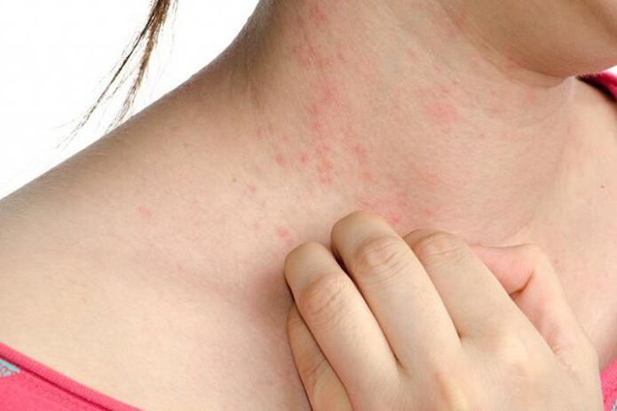 Exacerbations of psoriasis manifest as rash and severe itching