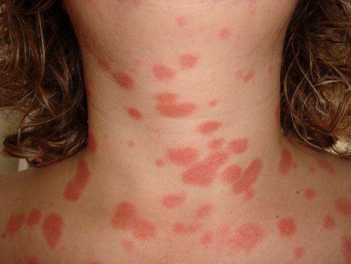 psoriasis plaques on skin