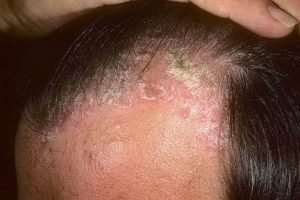 Psoriasis on the scalp