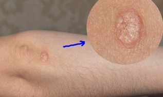 Stages of development of psoriasis