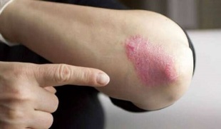 The stable stage of psoriasis development
