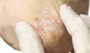 Treatment of psoriasis in decay period