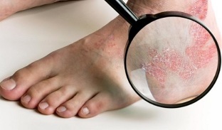 Treatment options for psoriasis