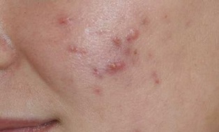 Early symptoms of psoriasis
