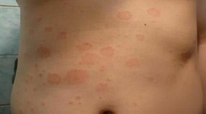 How to recognize the early stages of psoriasis