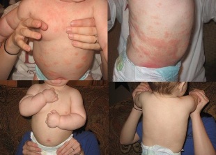 children psoriasis
