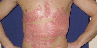 instructions for the integrated management of the treatment of psoriasis