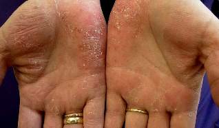 drugs for psoriasis