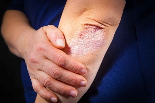 The psoriasis on the elbows