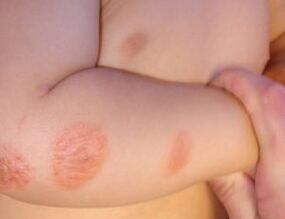 psoriasis child symptoms apró piros foltok az ujjakon