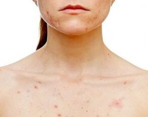 Where does psoriasis appear on the body 
