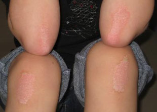 the psoriasis on the elbows