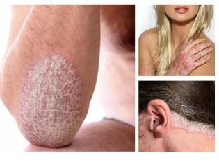 What is psoriasis and how to cure it